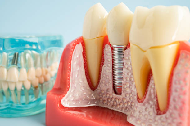 Best Root Canal Treatment  in Luck, WI